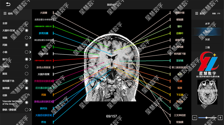 脑部MRI-冠状 脑部MRI-冠状