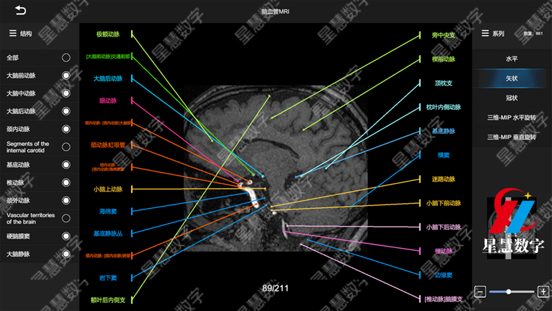 脑血管MRI--矢状 脑血管MRI--矢状