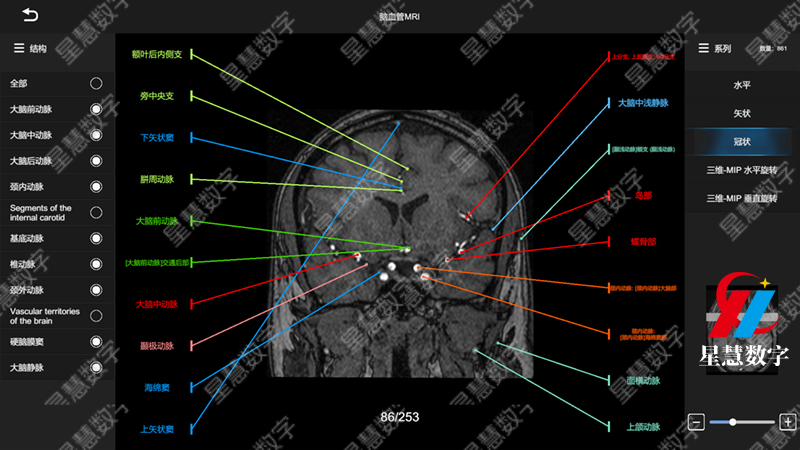 脑血管MRI--冠状 脑血管MRI--冠状