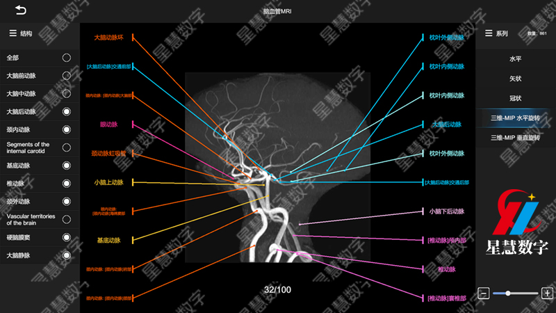 脑血管MRI--MIP水平旋转 脑血管MRI--MIP水平旋转