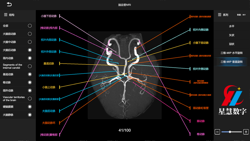 脑血管MRI--MIP垂直旋转 脑血管MRI--MIP垂直旋转