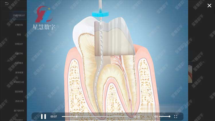 隐裂牙-根管治疗 隐裂牙-根管治疗