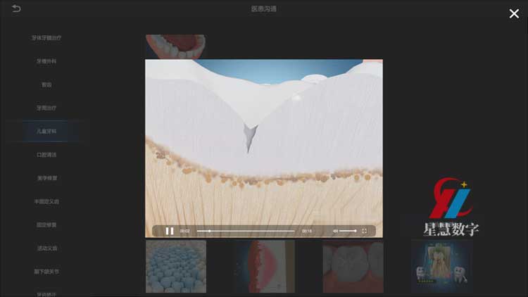 窝沟龋危害 窝沟龋危害