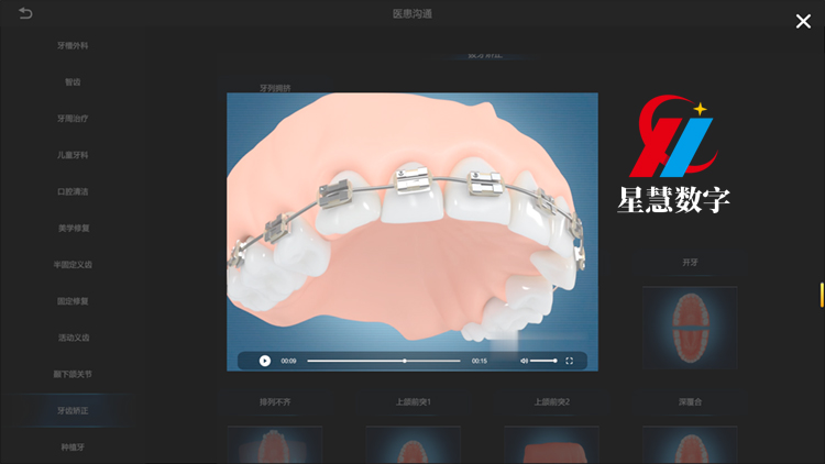 牙列拥挤 牙列拥挤