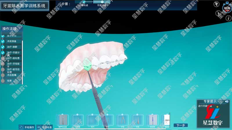 牙龈分离 牙龈分离