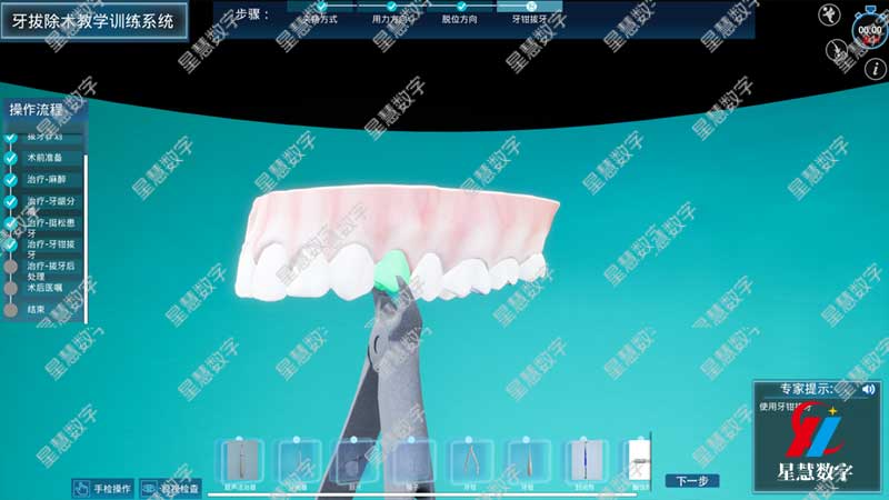 牙钳拔牙 牙钳拔牙