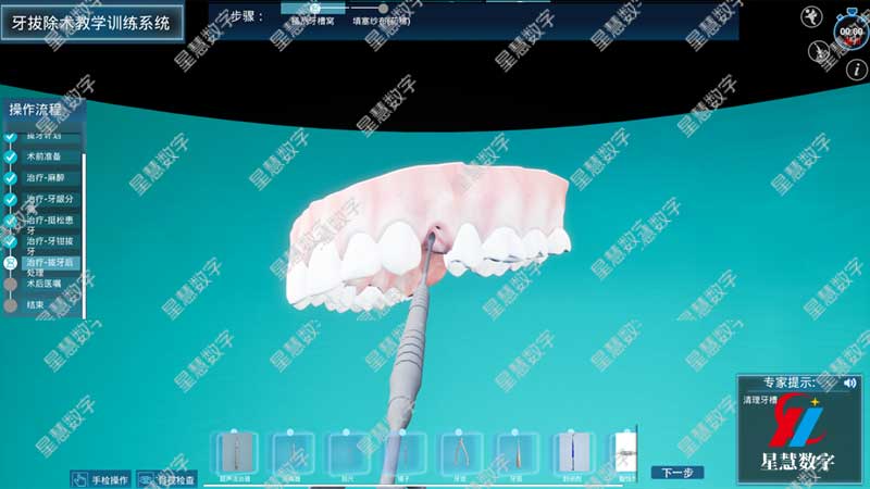 拔牙后处理 拔牙后处理