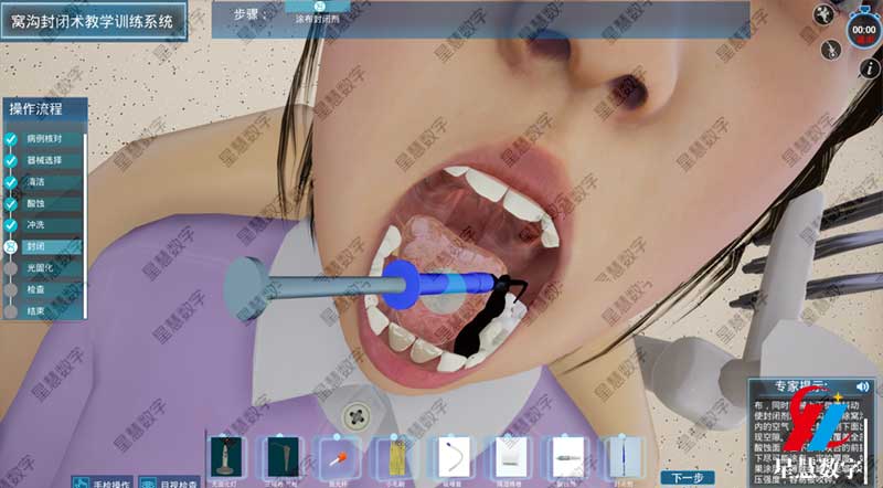 窝沟封闭之酸蚀 窝沟封闭之酸蚀