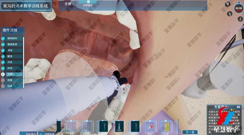 窝沟封闭之光固化 窝沟封闭之光固化