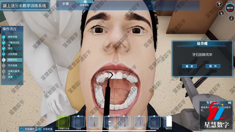 刮除牙石 刮除牙石